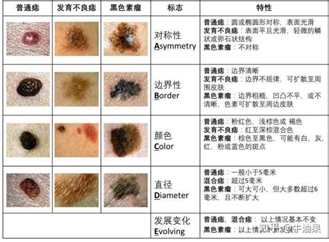 斑和痣|如何区分痣、老年斑、色素沉积、尸斑？